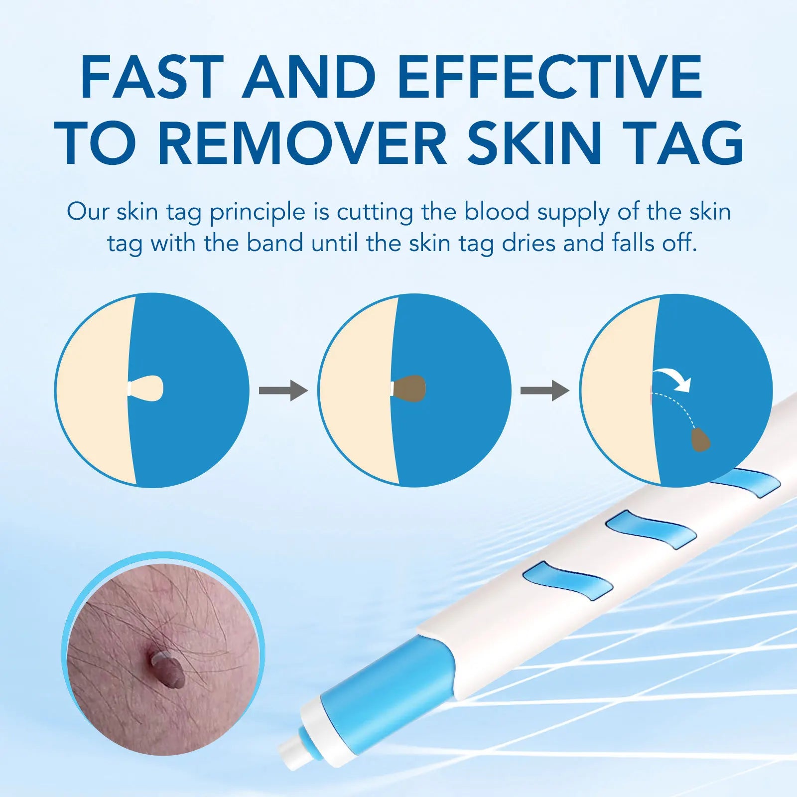 3 In1 Painless Auto Skin Tag Mole Wart Removal Kit Cleaning Tool Care Body Wart Dot Treatment for 1-4Mm Beauty Health Hot Sale